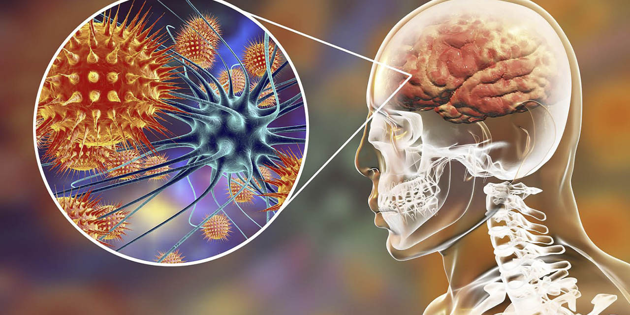 La meningitis produce una inflamación de los tejidos que rodean el cerebro.