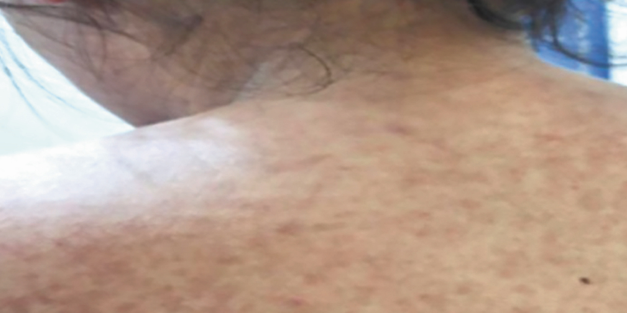 La enfermedad de sarampión es contagiosa.