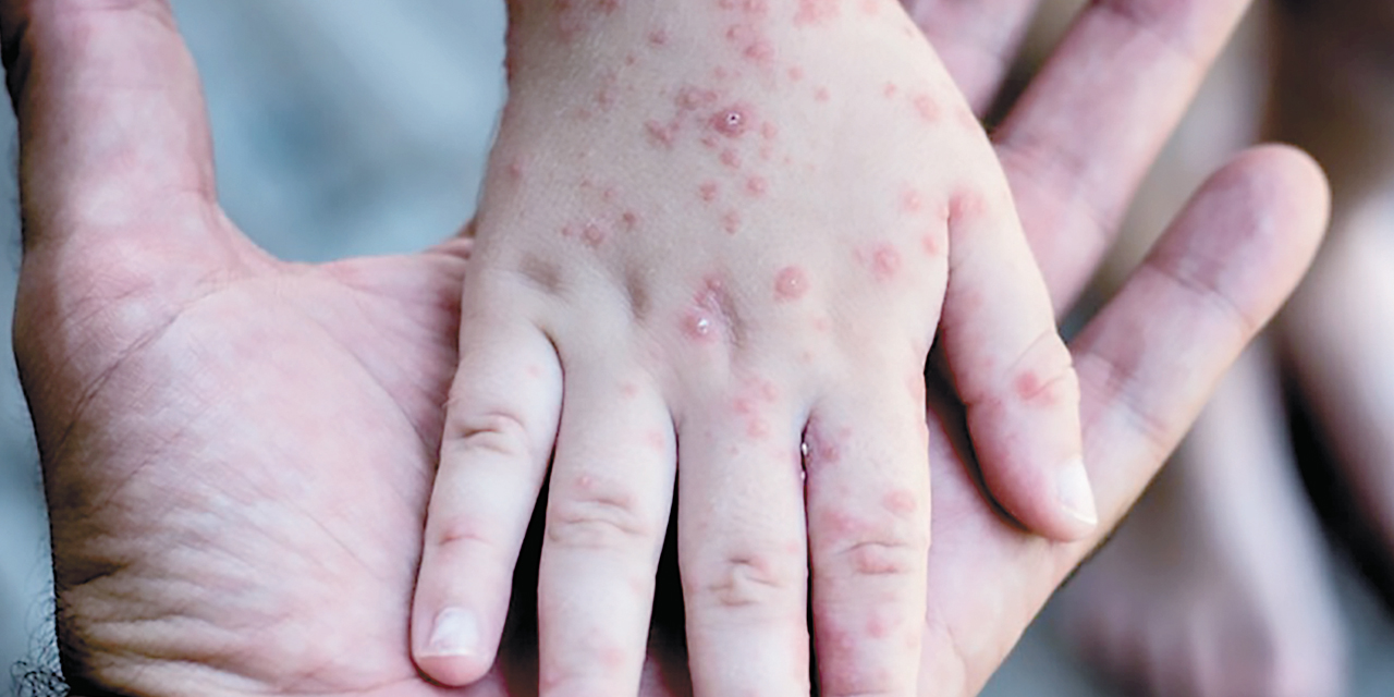  Se trata de un niño de 11 años que tenía nexo epidemiológico.