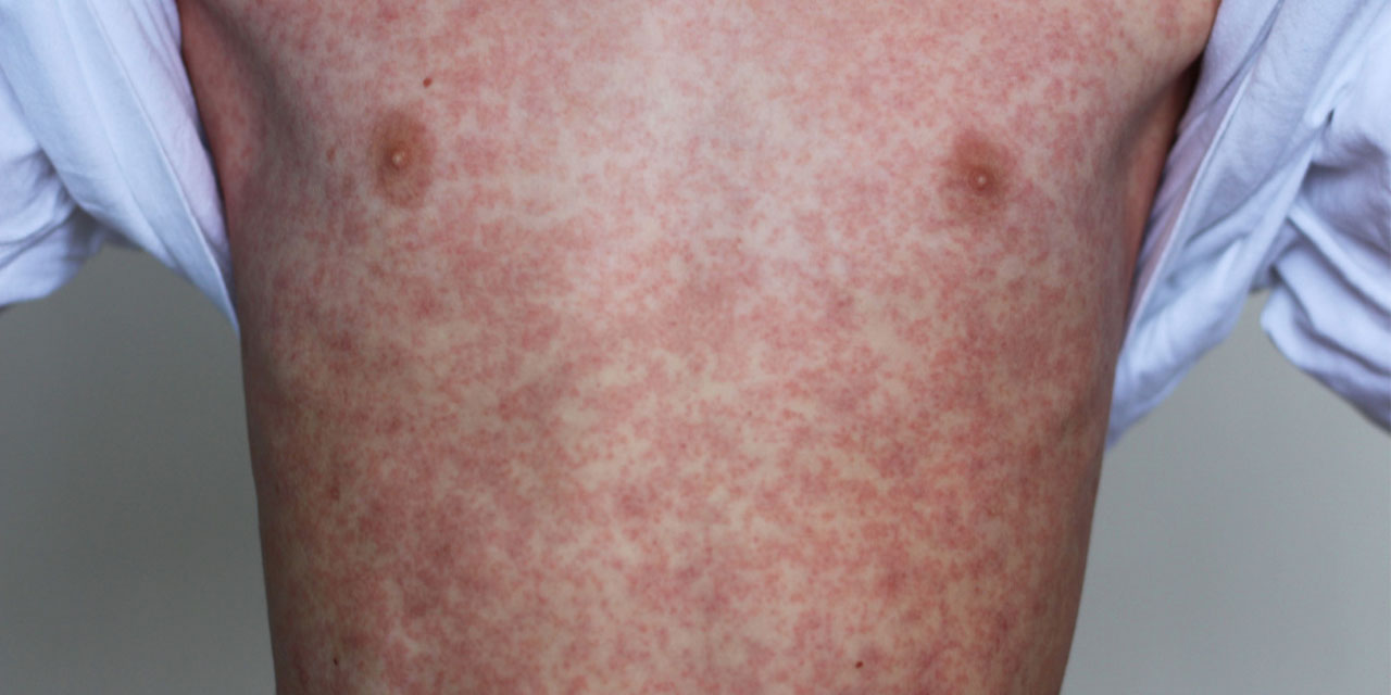 Imagen referencial de la enfermedad infecciosa.