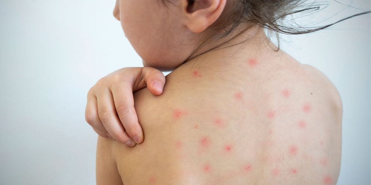 Imagen referencial de un niño con sarampión.